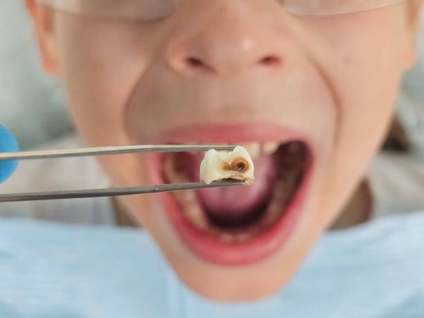 Best Emergency Gum Treatment in Mamou, LA